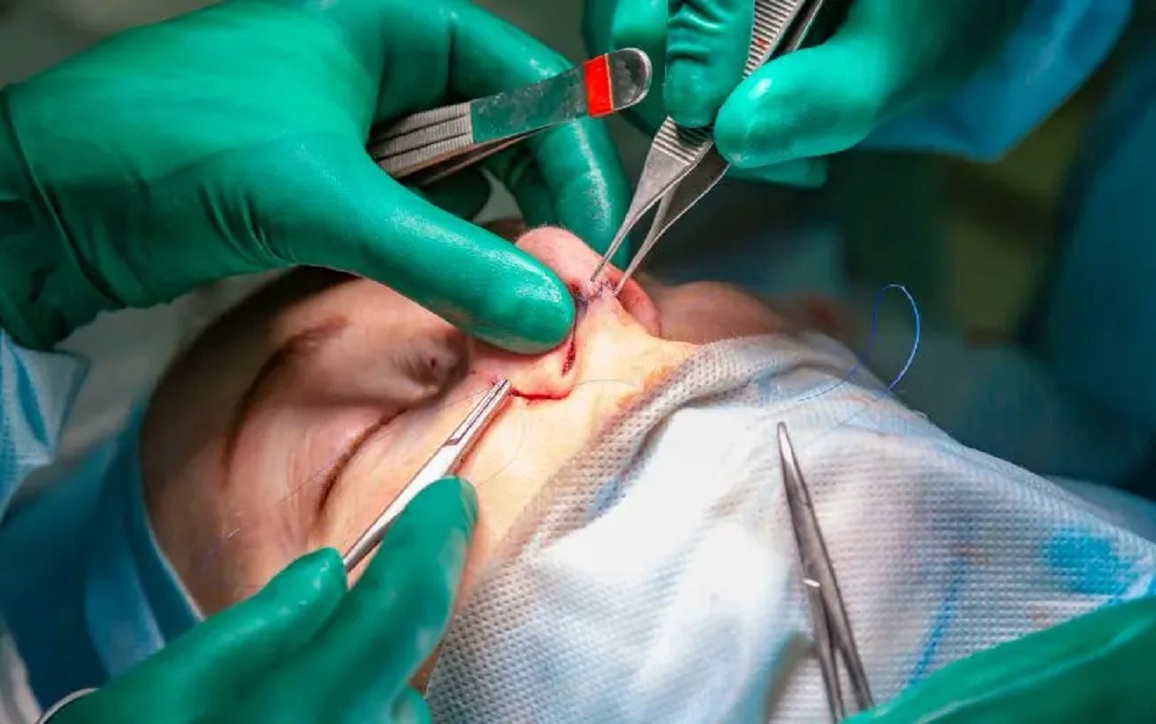 Rhinoplasty (Nose Reshaping Surgery)