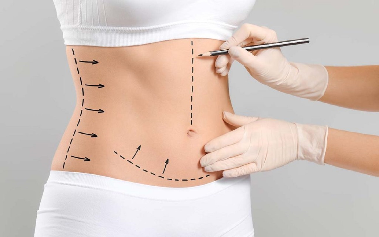Abdominoplasty (Tummy Tuck Surgery)